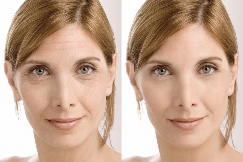 Experiencia de uso antes y después de usar la crema intenskin de Milana
