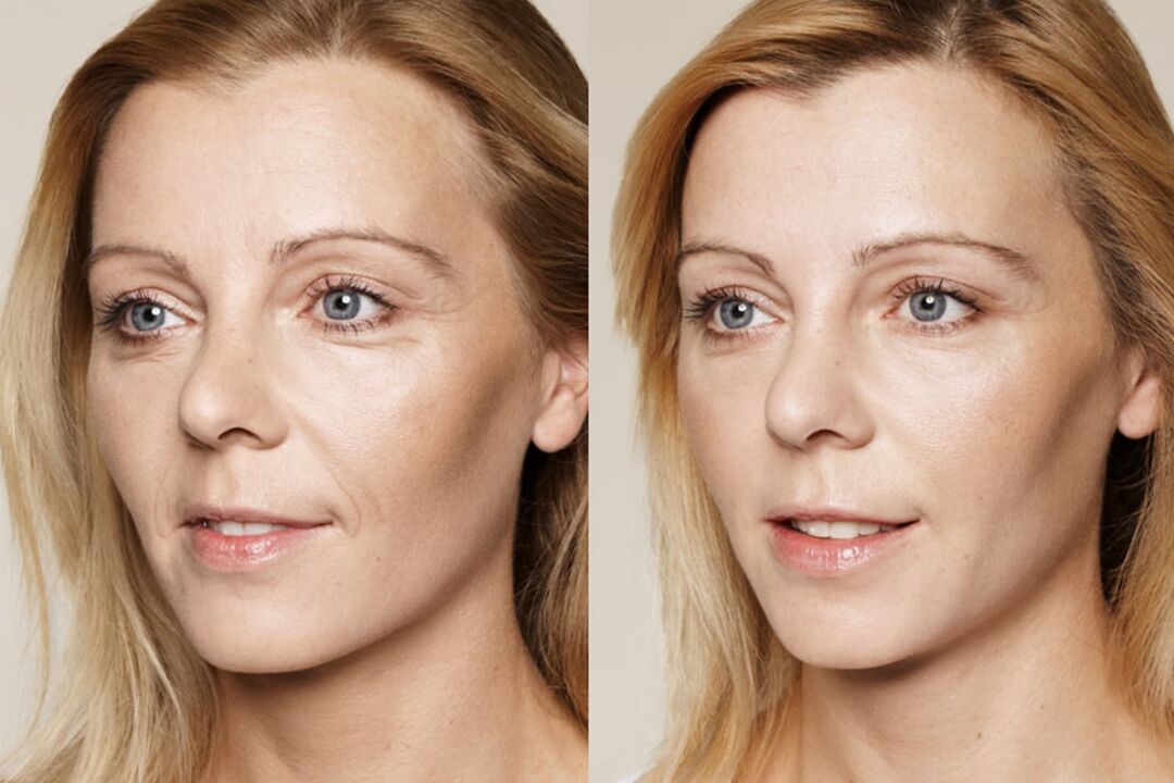 Experiencia de uso antes y después de usar la crema intenskin de Valeria
